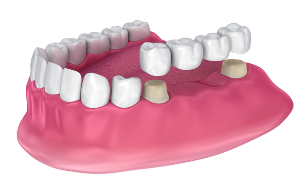 dental-bridges