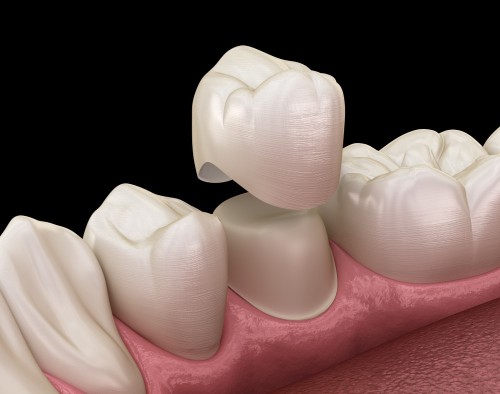 dental-crowns