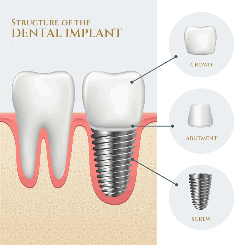 dental_implants