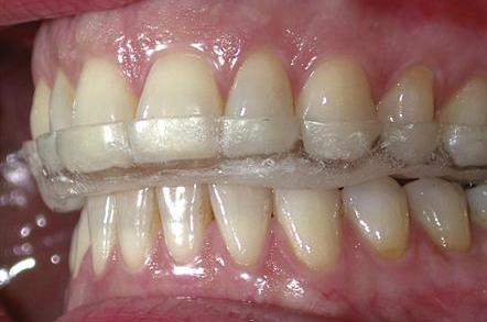 occlusal-splint