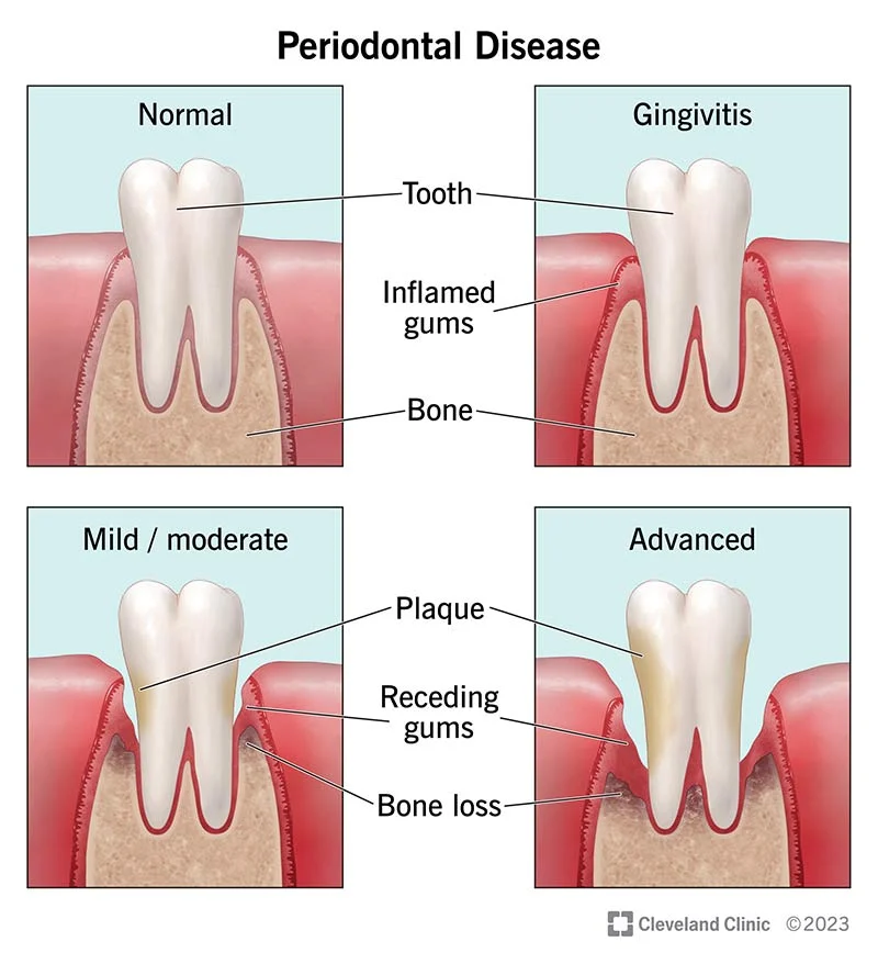 periodontal-disease
