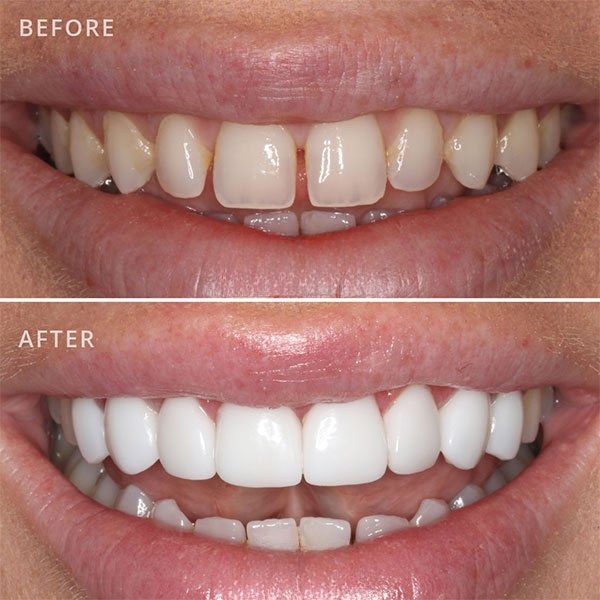 porcelain-veneers