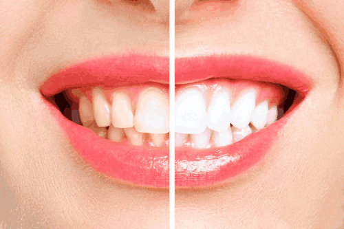 Teeth_whitening